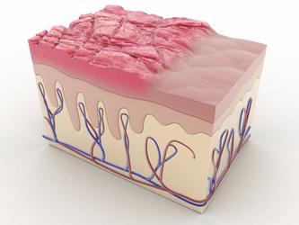 illustration du psoriasis